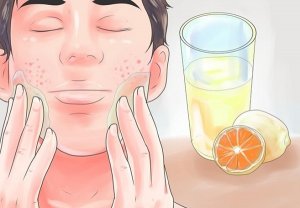 علاج حب الشباب طبيعيا بسرعة بالمنزل علاج حب الشباب في الوجه بسرعه 300x208 علاج حب الشباب طبيعيا بسرعة بالمنزل