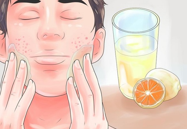 علاج-حب-الشباب-في-الوجه-بسرعه