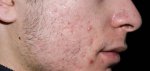 علاج حب الشباب بكل الطرق 19 طريقة امريكية فعالة وتحدى علاج حب الشباب بكل الطرق 19 طريقة امريكية فعالة وتحدى
